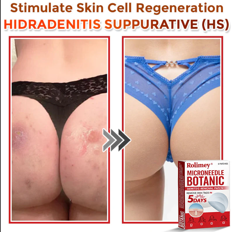 🌈Rolimey® MicroNeedle Botanic Skin Tag Removal Patch 🇺🇸 Made in the USA